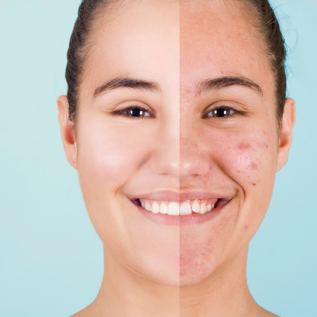 Acne Clearing Bootcamp Before and After